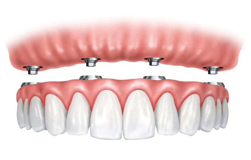 Benefits Of Same Day Dental Implants